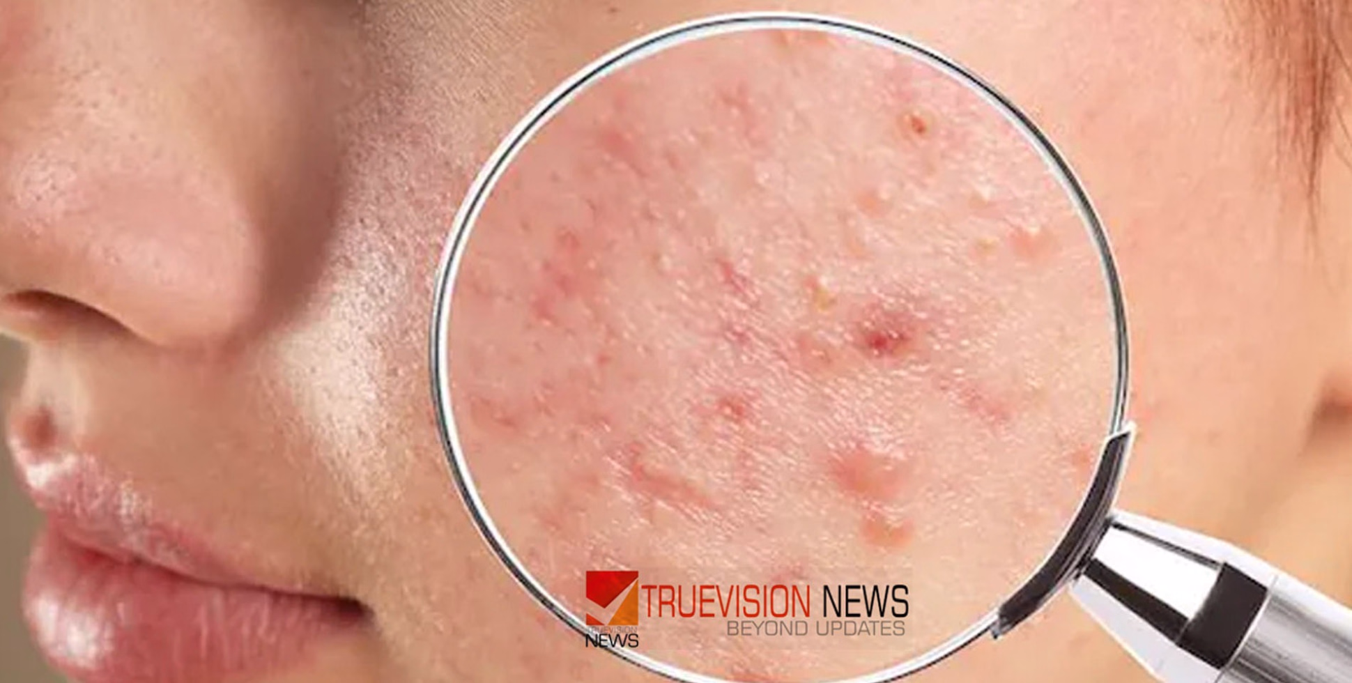 ചൂടുകാലത്തെ മുഖക്കുരുവിനോട് വിട പറയാം; തിളക്കമുള്ള ചർമ്മത്തിനായി ഈ  കാര്യങ്ങൾ ശ്രദ്ധിക്കൂ...