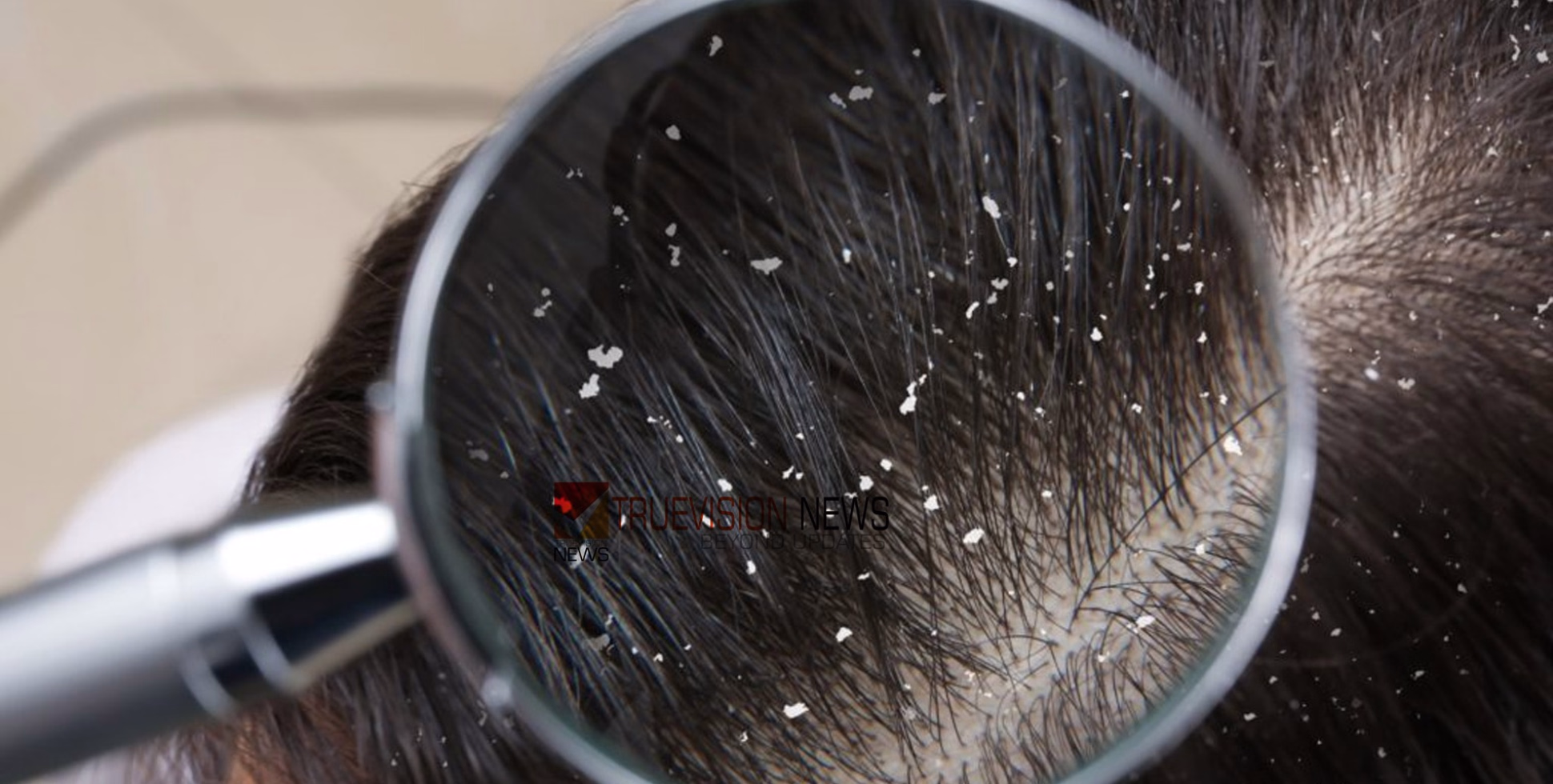 ചൊറിച്ചിലും വെളുത്ത പൊടിയും മടുത്തോ? വെറും 10 രൂപയിൽ താരനെ തുരത്താം, ഇങ്ങനെ ചെയ്യൂ ...