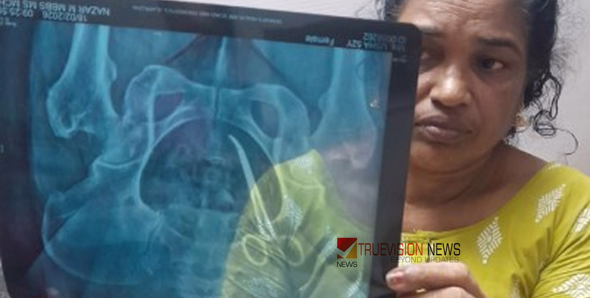 അഞ്ചുവർഷം വയറ്റിൽ കത്രികയുമായി വീട്ടമ്മ; വണ്ടാനം മെഡിക്കല്‍ കോളജ് ആശുപത്രിയിലെ ശസ്ത്രക്രിയയ്ക്കിടെ കുടുങ്ങിയതെന്ന് ആരോപണം